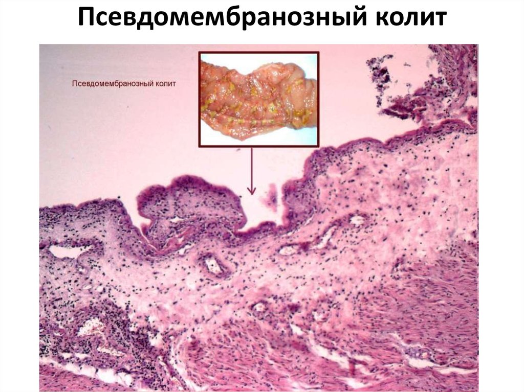 Псевдомембранозный колит