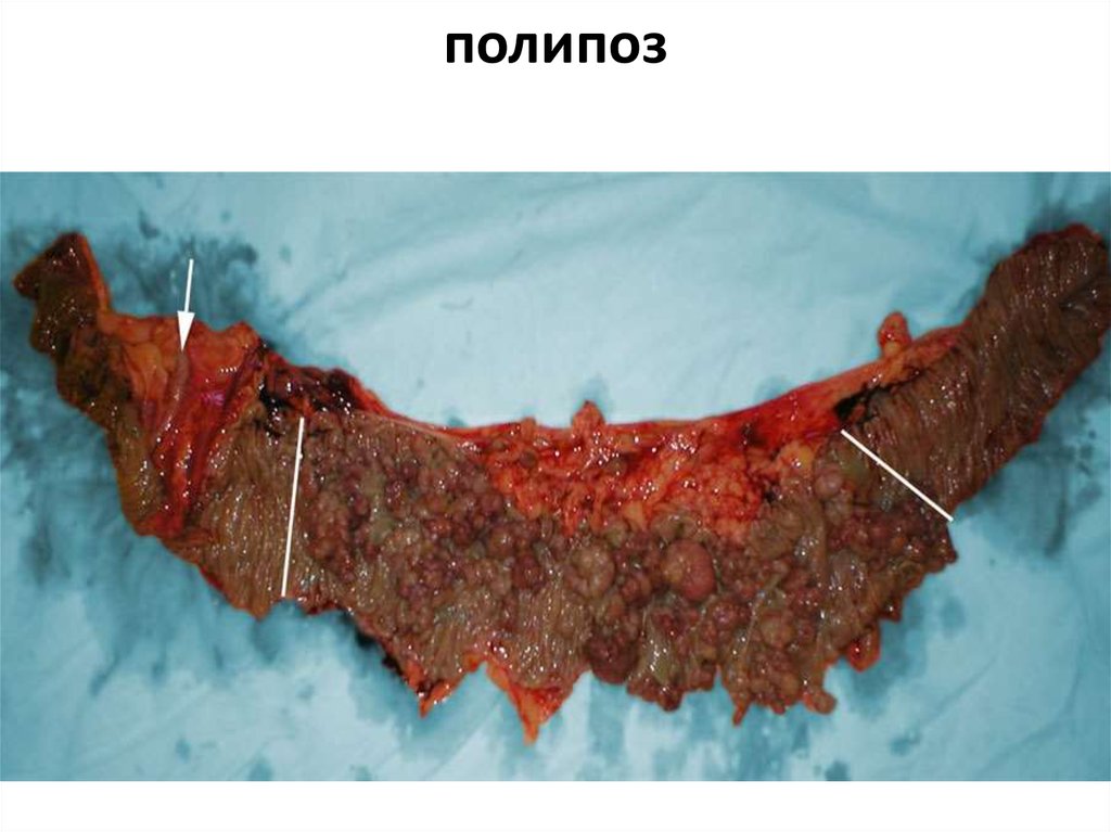полипоз