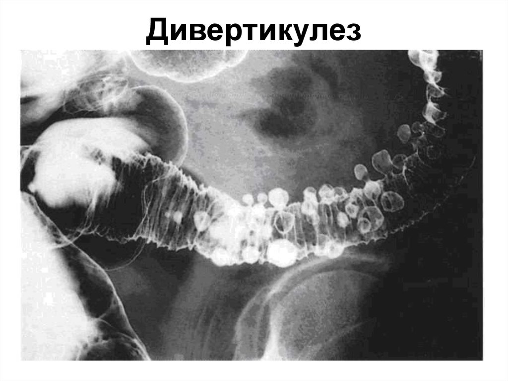 Болезни толстого. Дивертикул кишечника рентген. Дивертикулы толстой кишки Рент. Дивертикулез ободочной кишки ирригоскопия. Дивертикулез сигмовидной кишки ирригоскопия.