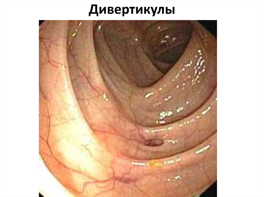 Дивертикулы
