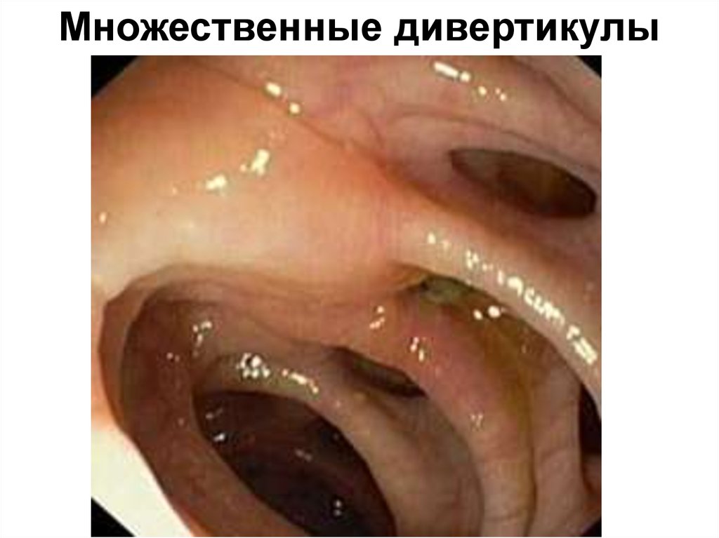 Множественные дивертикулы