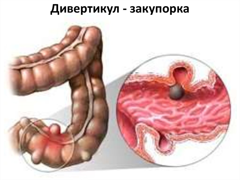 Дивертикул - закупорка