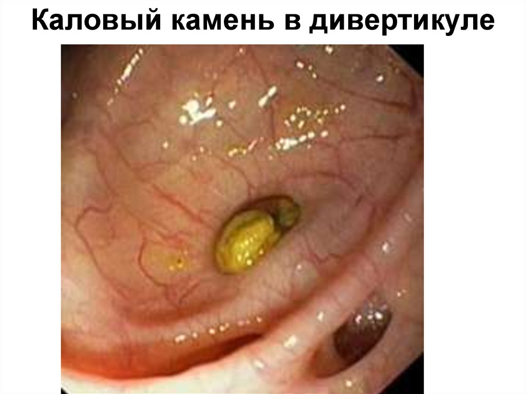 Каловый камень в дивертикуле