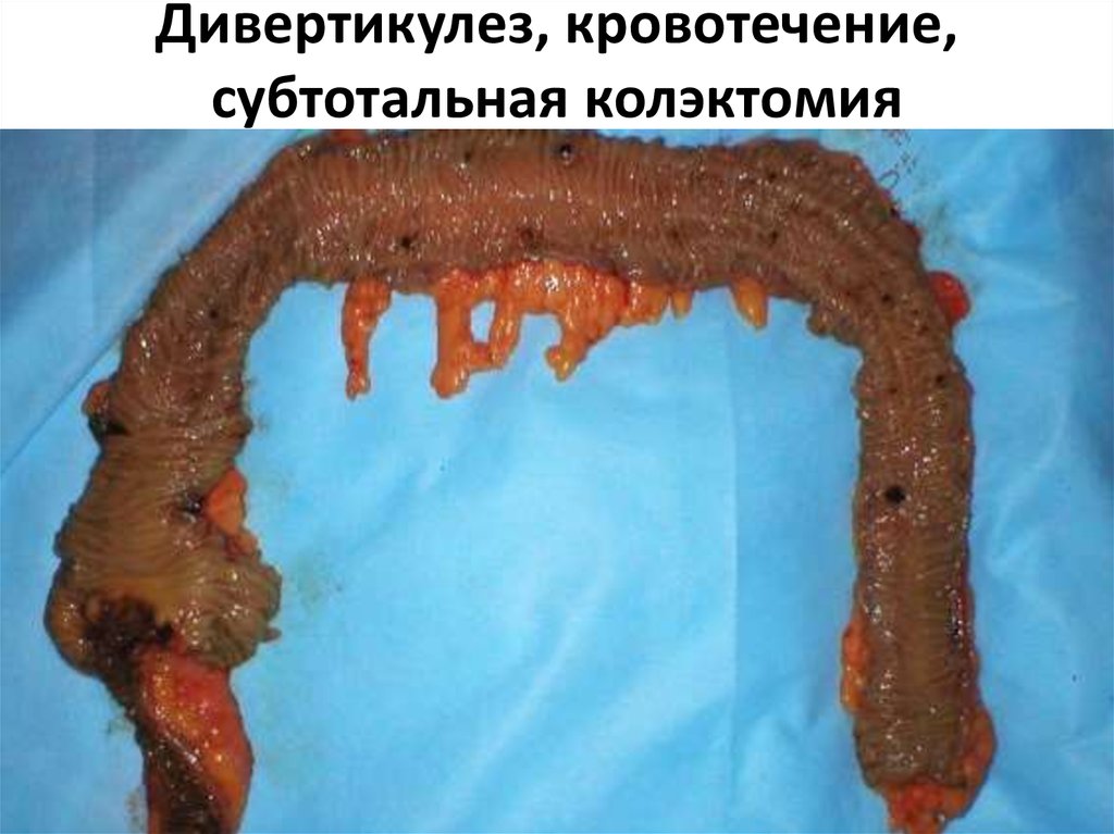 Дивертикулез, кровотечение, субтотальная колэктомия