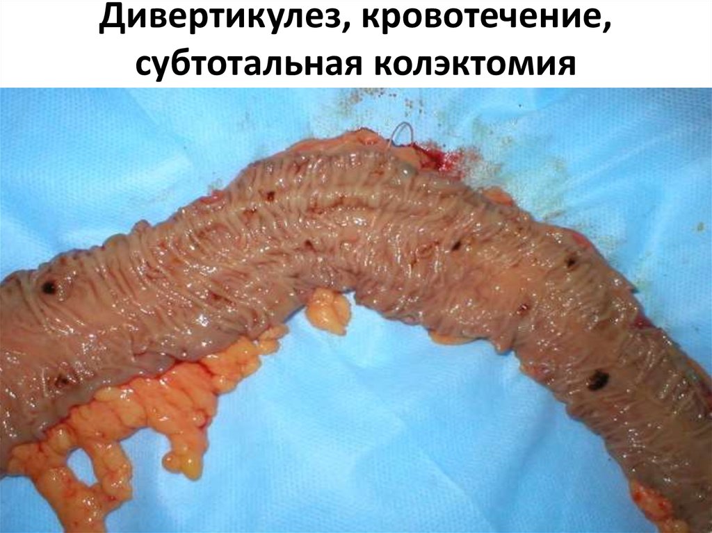 Дивертикулез, кровотечение, субтотальная колэктомия