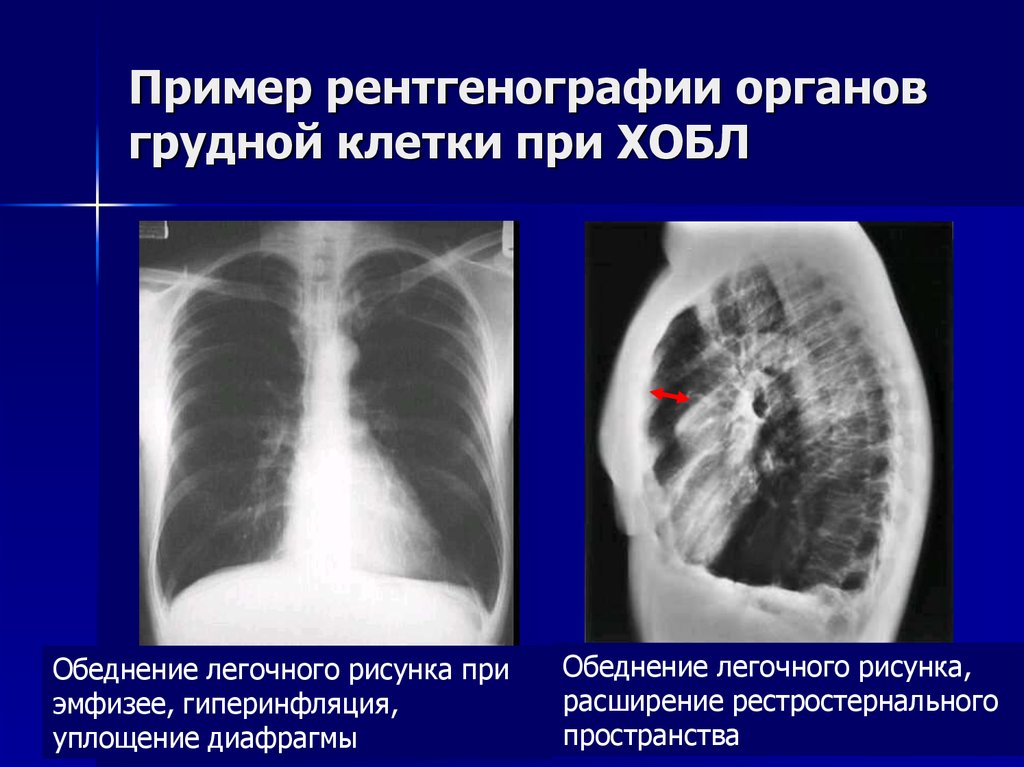 Что показывает рентген при кашле. Рентген грудной клетки ХОБЛ. Хроническая обструктивная болезнь лёгких рентген. Рентген при ХОБЛ эмфизема. Рентгенография органов грудной клетки при ХОБЛ.