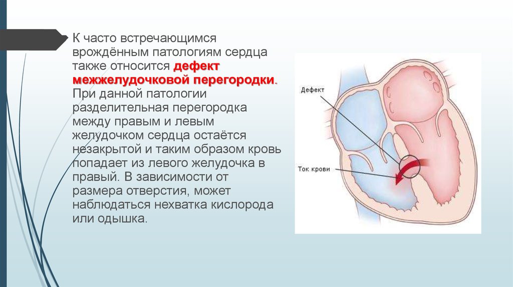 Аневризма межпредсердной перегородки у взрослых прогноз. Перегородка между правым и левым желудочком. Врожденная аномалия сердечной перегородки. Перегородка левого желудочка сердца. Истончение перегородки сердца у взрослого.