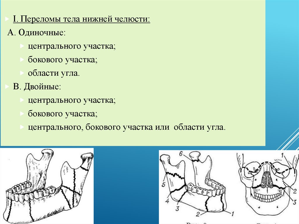 Переломы нижней челюсти стоматология презентация