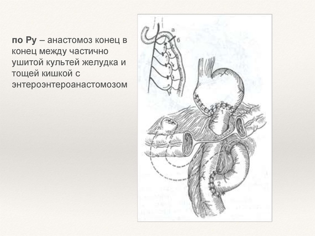 Анастомоз по ру схема