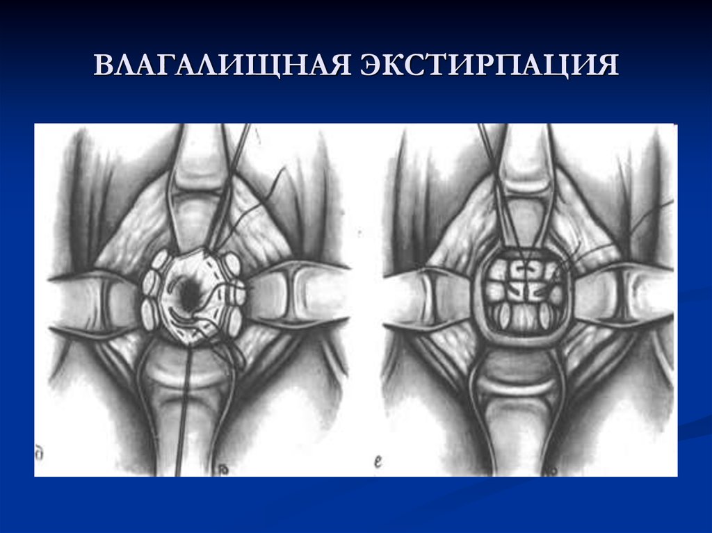 Презентация экстирпация матки