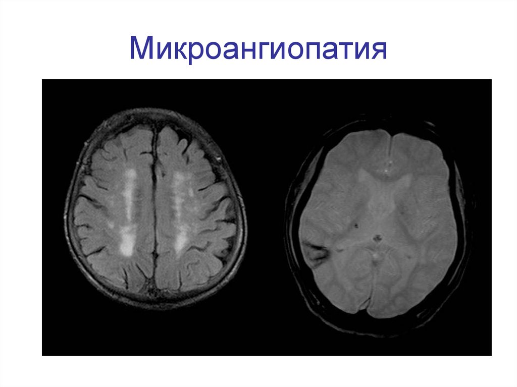 Микроангиопатия головного мозга fazekas