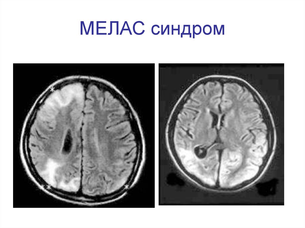 Синдром мелас презентация