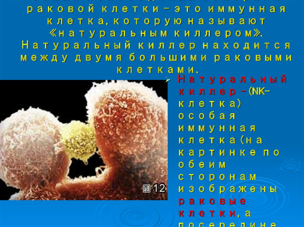 Самый непобедимый соперник раковой клетки – это иммунная клетка, которую называют «натуральным киллером». Натуральный киллер находится м