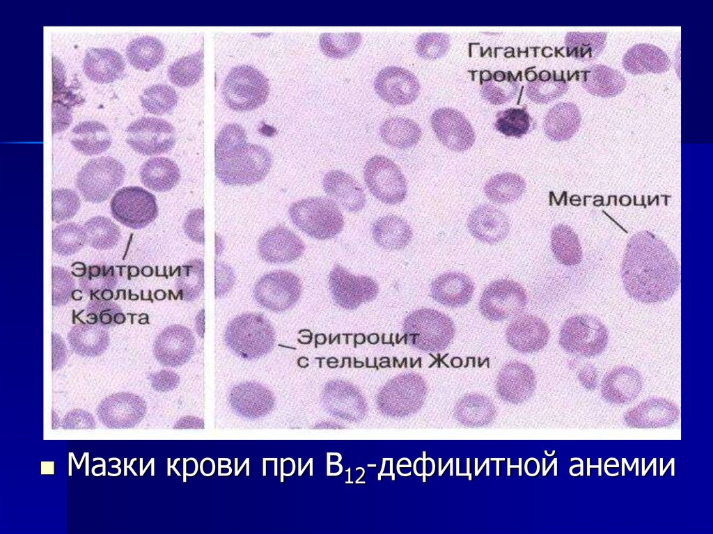 Картина крови при анемии