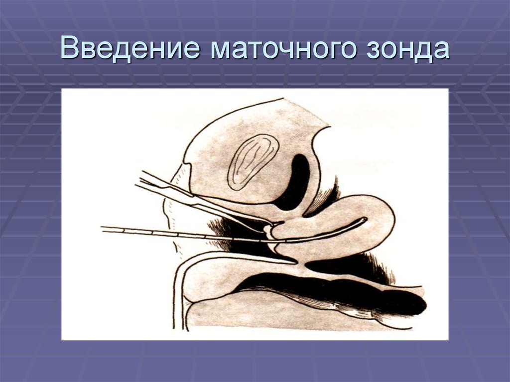 Выскабливание полости. Маточный зонд. Зондирование полости матки. Набор для зондирования полости матки. Зондирование полости матки инструменты.