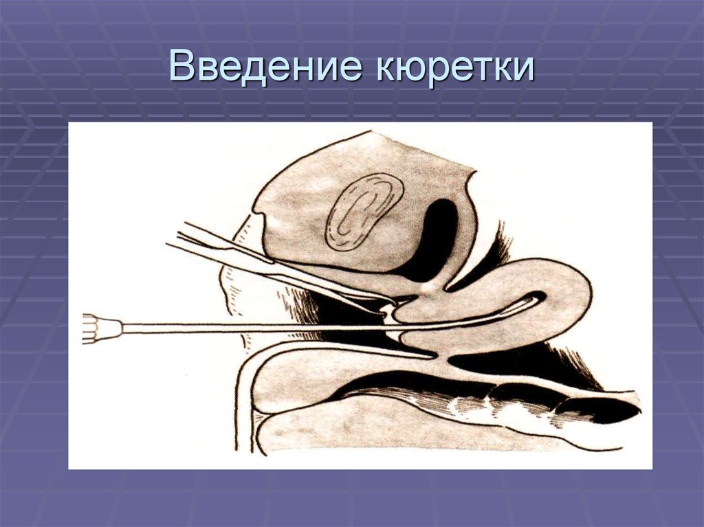 Выскребание полости матки. Лечебно-диагностическое выскабливание полости матки инструменты. Кюретка для выскабливания полости матки. Инструменты для диагностического выскабливания полости матки. Фракционное диагностическое выскабливание.