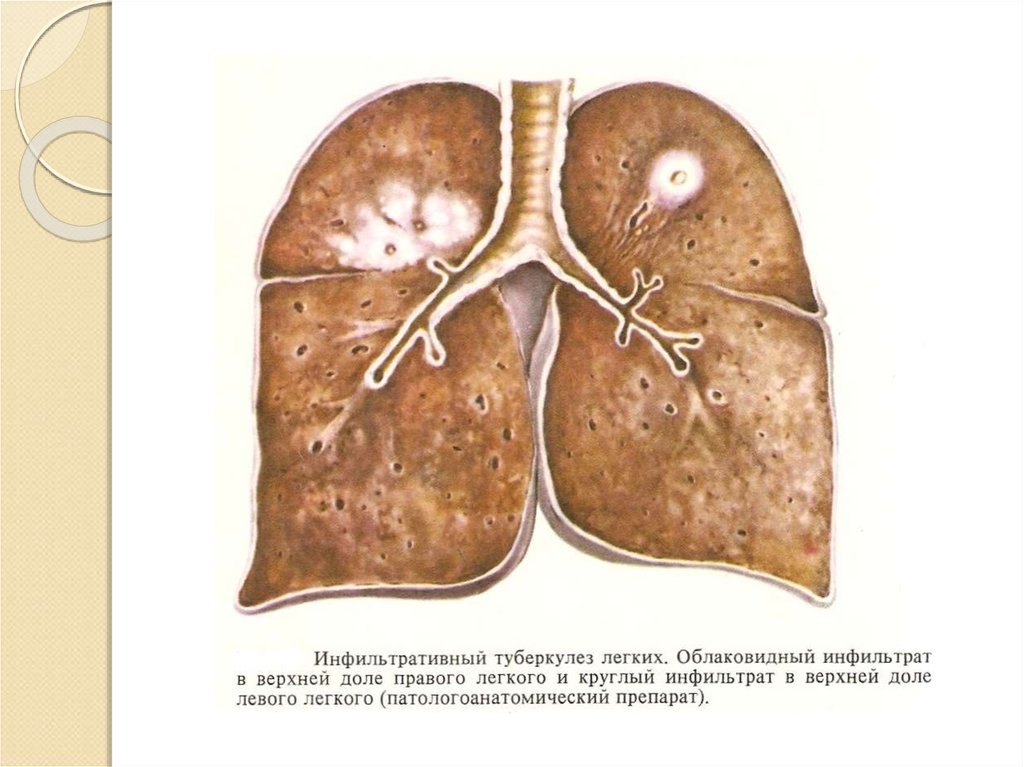 Инфильтративный туберкулез верхних долей легких. Туберкулез с6 правого легкого инфильтративный. Инфильтративный туберкулёз с1 с2 с6. Инфильтративный туберкулез легких. Инфильтративный туберкулез легких облаковидный.