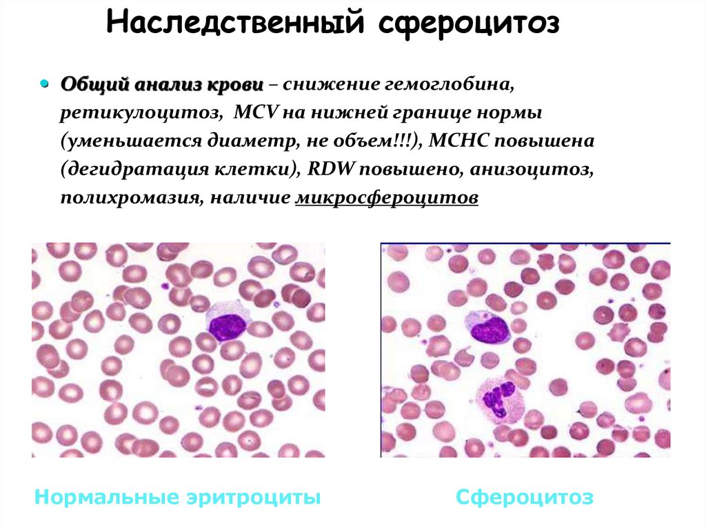 Анизоцитоз в общем анализе крови. Наследственный микросфероцитоз картина крови. Наследственный микросфероцитоз анализ крови. Наследственный сфероцитоз. Наследственное сферацитоз это.