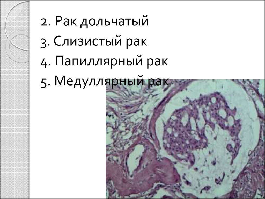 Медуллярный рак. Медуллярный и папиллярный. Дольчатое строение опухоли. Инвазивная дольчатая карцинома.