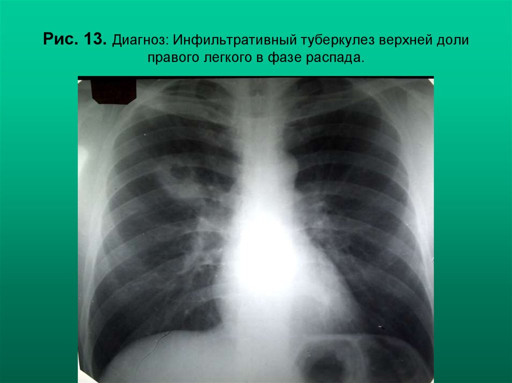 Инфильтративного в фазе распада. Инфильтративный туберкулез рентгенография. Инфильтративный туберкулез правого легкого в фазе инфильтрации. Инфильтративный туберкулез с распадом рентген. Инфильтративный туберкулез легкого рентген.
