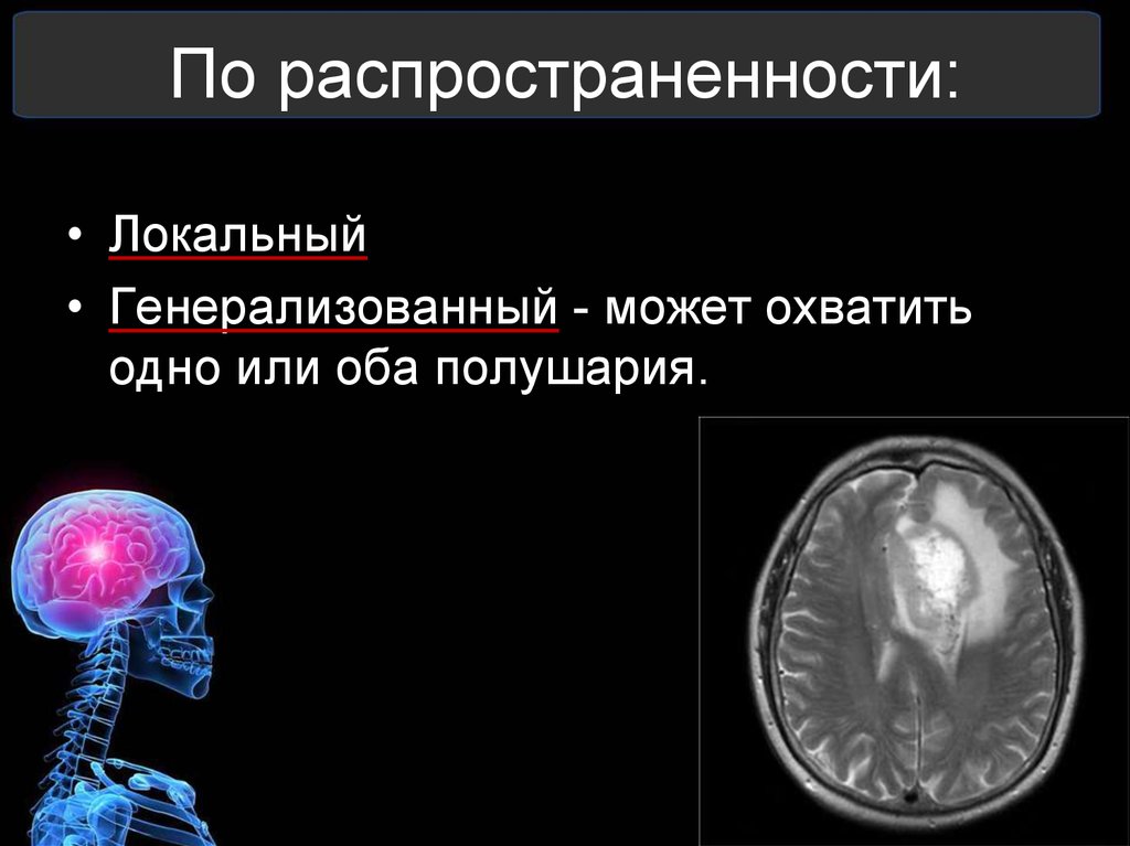 Оттек мозга. Отек мозга генерализованный. Отек мозга презентация. Осмотический отек мозга. Генерализованные отеки.