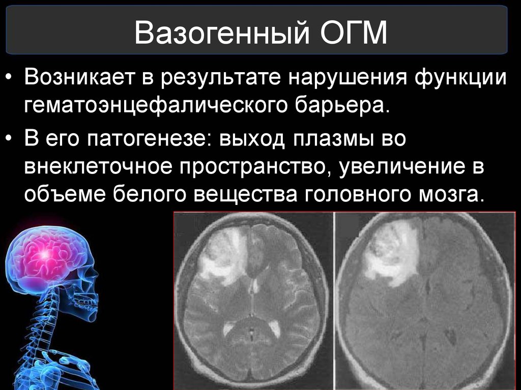Вазогенный очаг больших полушарий. Вазогенный отек головного мозга кт. Механизм развития отека головного мозга. Этиология отека головного мозга.
