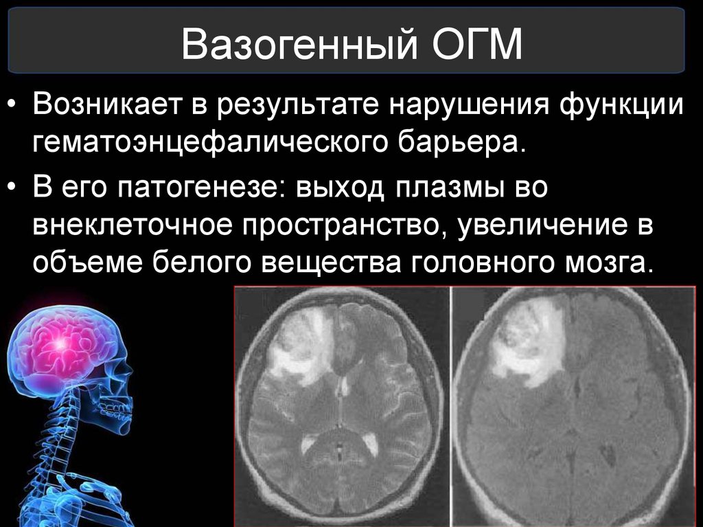 Отек мозга. Вазогенный отек головного мозга кт. Механизм развития отека головного мозга. Отек набухание головного мозга патогенез. Симптом являющийся признаком развивающегося отека головного мозга.