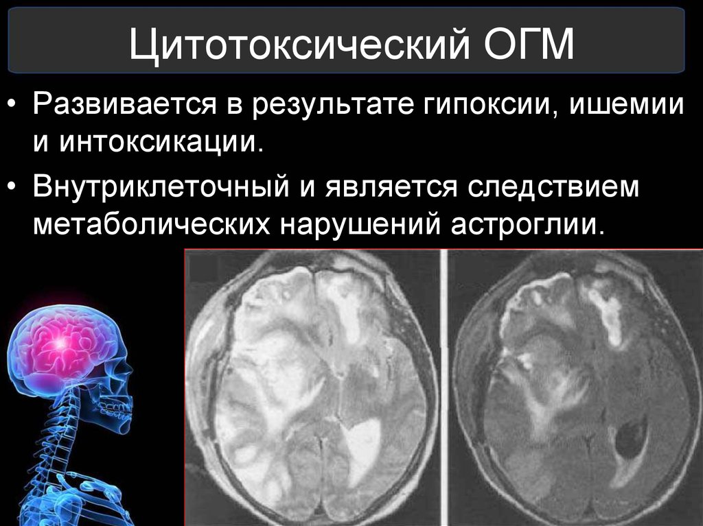 Отек мозга профилактика. Цитотоксический отёк головного мозга. Цитотоксический отек мозга на кт. Вазогенный отек головного мозга кт. Цитотоксический отек головного мозга кт.