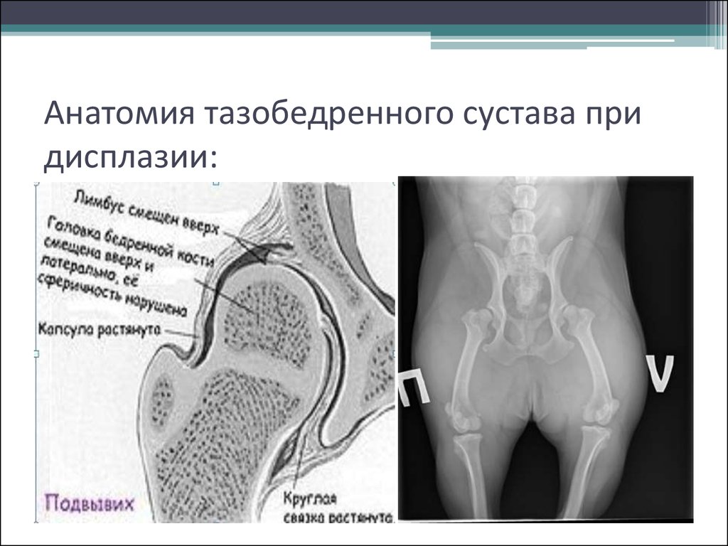 Презентация дисплазия тазобедренных суставов