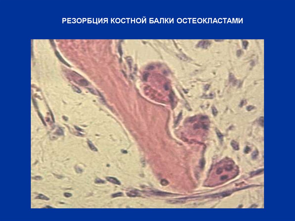 Резорбция это. Резорбция кости остеокластами. Участки резорбции костной ткани. Резорбция костной ткани гистология. Механизм резорбции костной ткани.