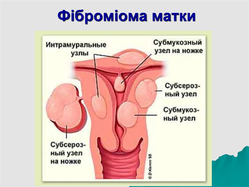 Субмукозная матка. Интрамурально субмукозный. Интрамурально-субмукозный узел что это такое. Интрамуральный субсерозный фиброматозный узел. Интрамуральный узел в матке.