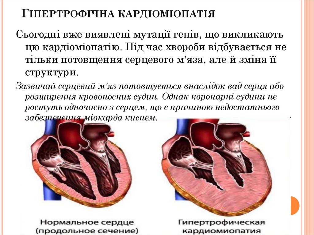 Кардиомиопатия сердца что это. Гипертрофическая кардиомиопатия поперечный разрез. 