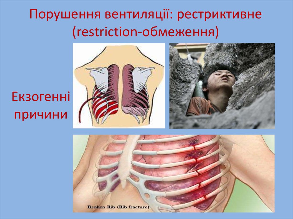 Порушення вентиляції: рестриктивне (restriction-обмеження)