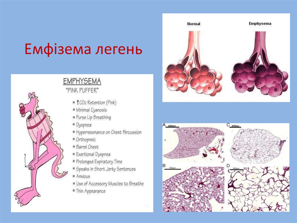 Патологія дихальної системи - online presentation