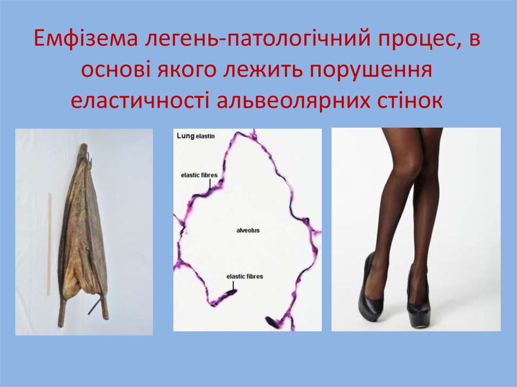 Емфізема легень-патологічний процес, в основі якого лежить порушення еластичності альвеолярних стінок