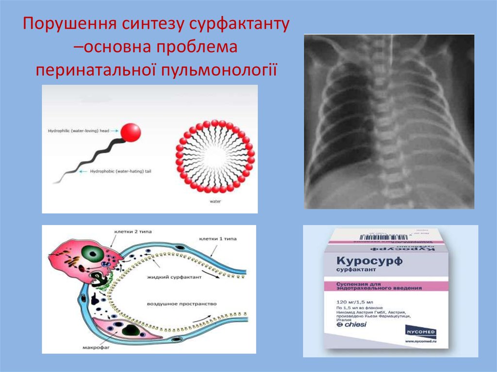 Порушення синтезу сурфактанту –основна проблема перинатальної пульмонології