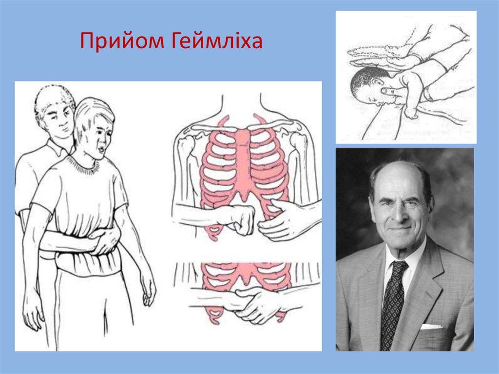 Прийом Геймліха