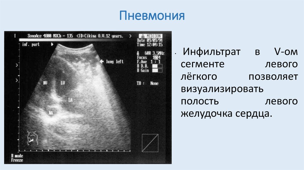 Узи легких. Коронавирусная пневмония на УЗИ. Ультразвуковое исследование легких и плевры. УЗИ плевральных полостей инфильтрат. УЗИ плевральной полости пневмония.