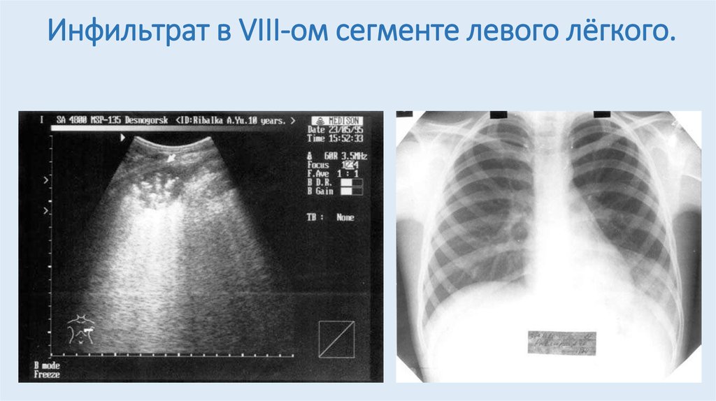 Узи легких. Эхография при пневмонии. Пневмония на УЗИ.