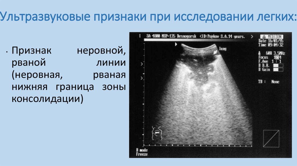 Узи признаки. Консолидация легких на УЗИ. В-линии на УЗИ легких. B-линии УЗИ легких.