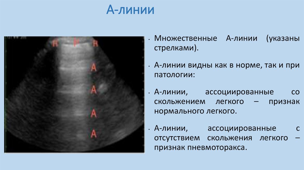 Линии легких. В-линии на УЗИ легких. УЗИ легкого пневмоторакс. УЗИ легкие а линии. Пневмоторакс на УЗИ.