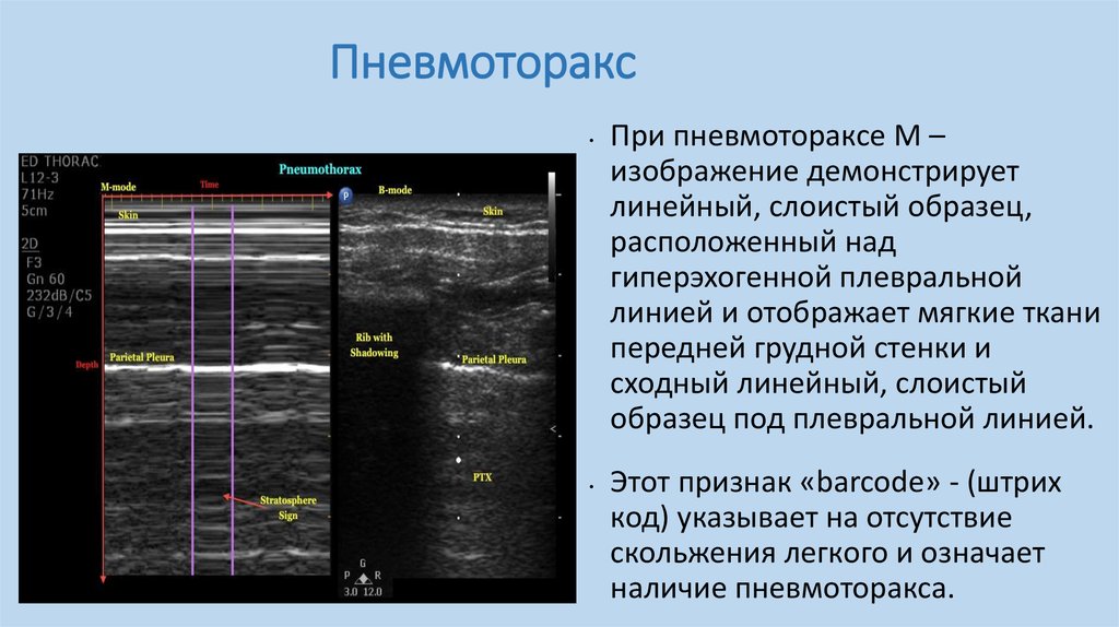 Узи мягких тканей филлер