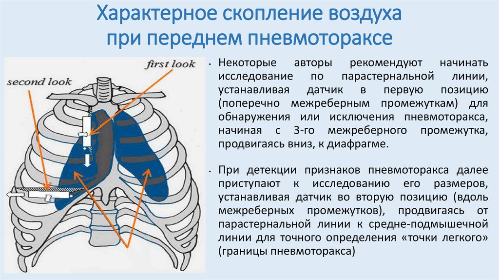 Парастернальная линия это