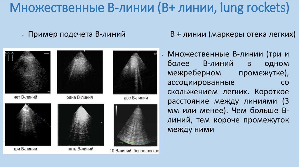 Узи легких протокол и плевры образец