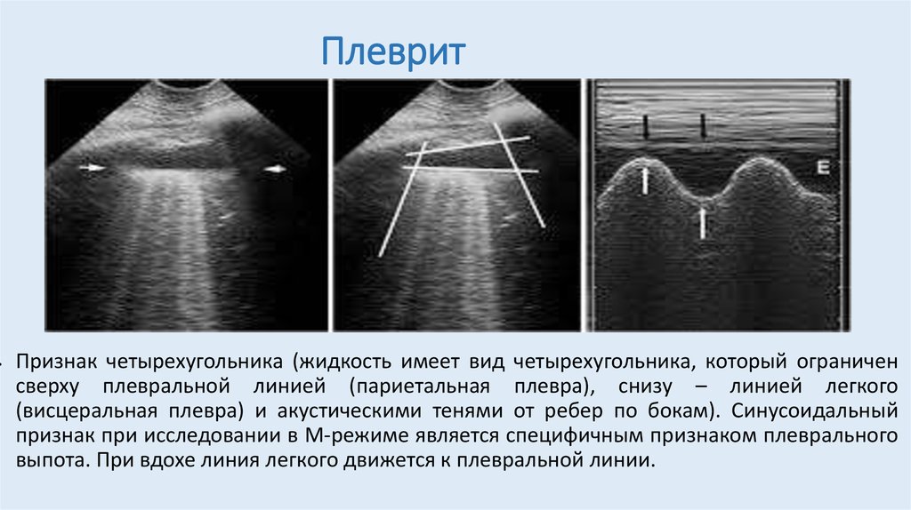 Узи плевральной