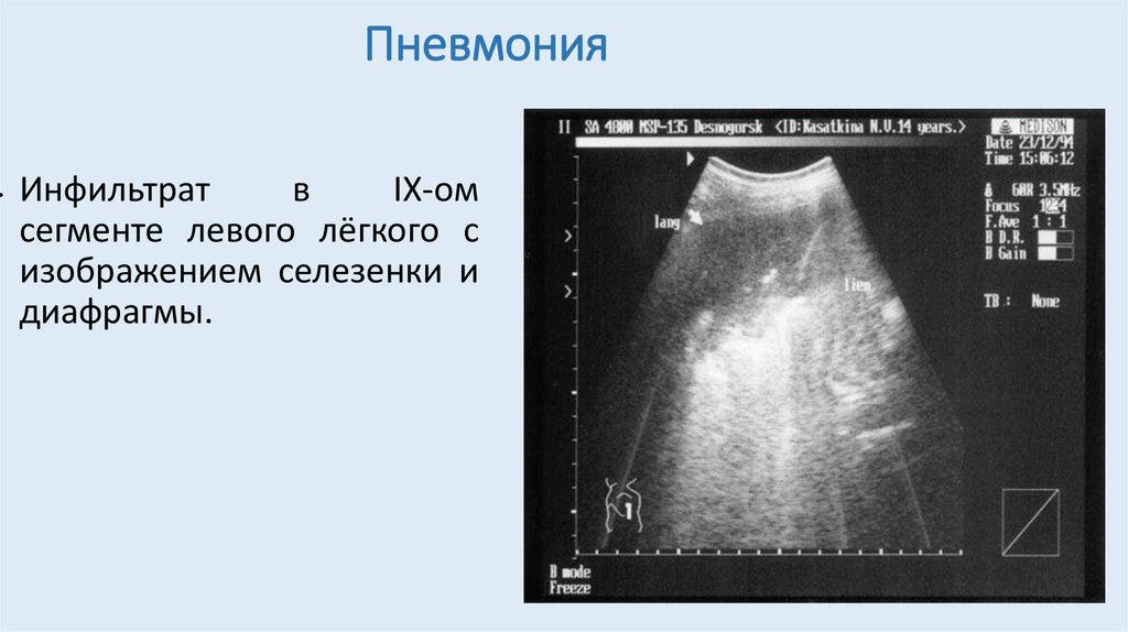 Узи плевральной. УЗИ плевральных полостей инфильтрат. Плеврит на УЗИ. УЗИ плеврита картина. Ультразвуковая диагностика плеврального выпота.