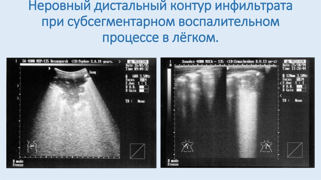 Жидкость в плевральной полости на узи фото