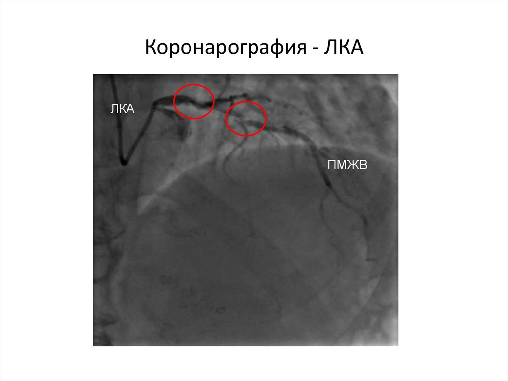 Левая коронарная артерия. Коронарография стеноз ПМЖВ. Стеноз ствола левой коронарной артерий коронарография. Коронарография с эксцентрическим стенозом ствола лка. Коронарография левой коронарной артерии.