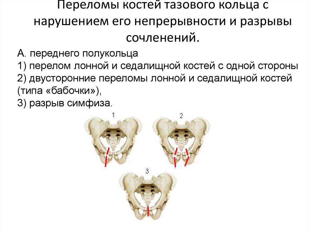 Перелом таза кости код