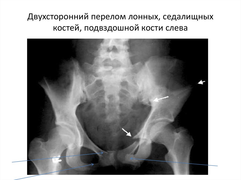 Левая седалищная кость где находится фото